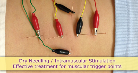 dry needling intramuscular stimulation effective treatment muscular trigger points point muscle red black needle wire skin acupuncture